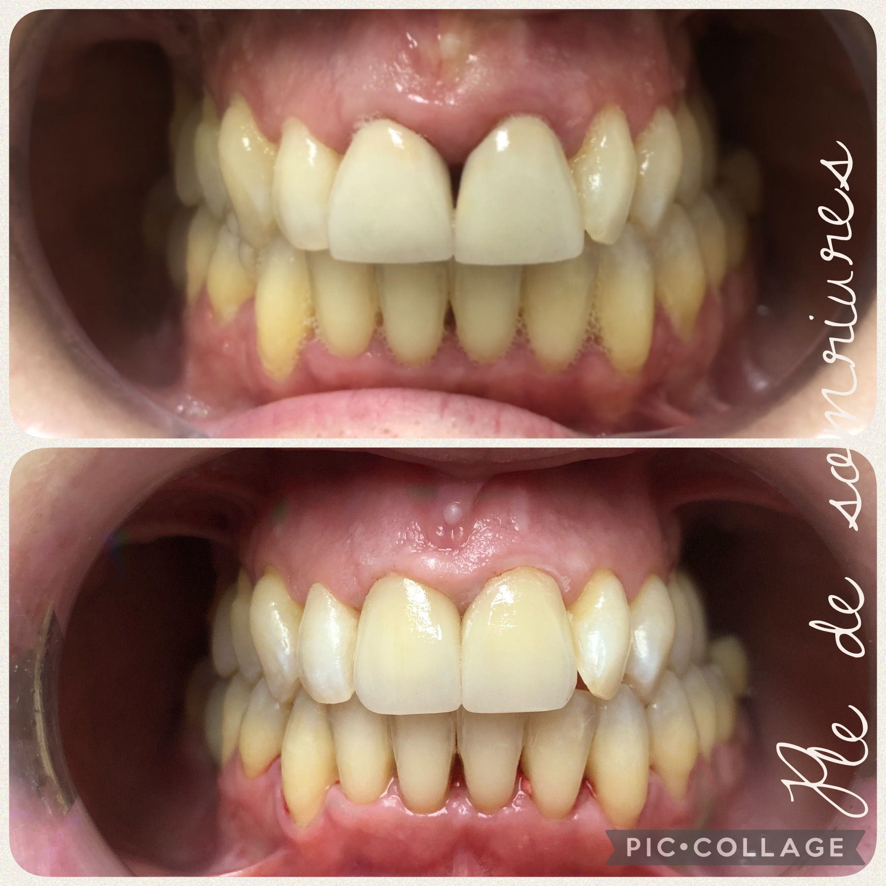 Corona de porcelana estratificada anterior vs potcelana