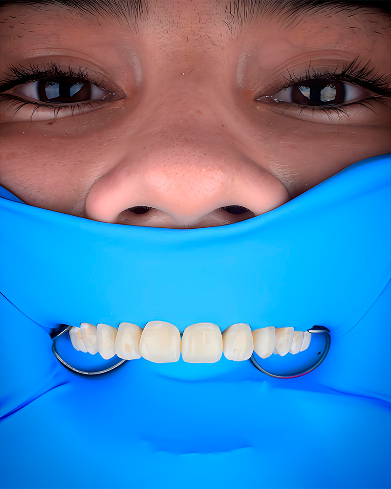 Paso 2: aislamiento del diente a tratar mediante dique de goma.