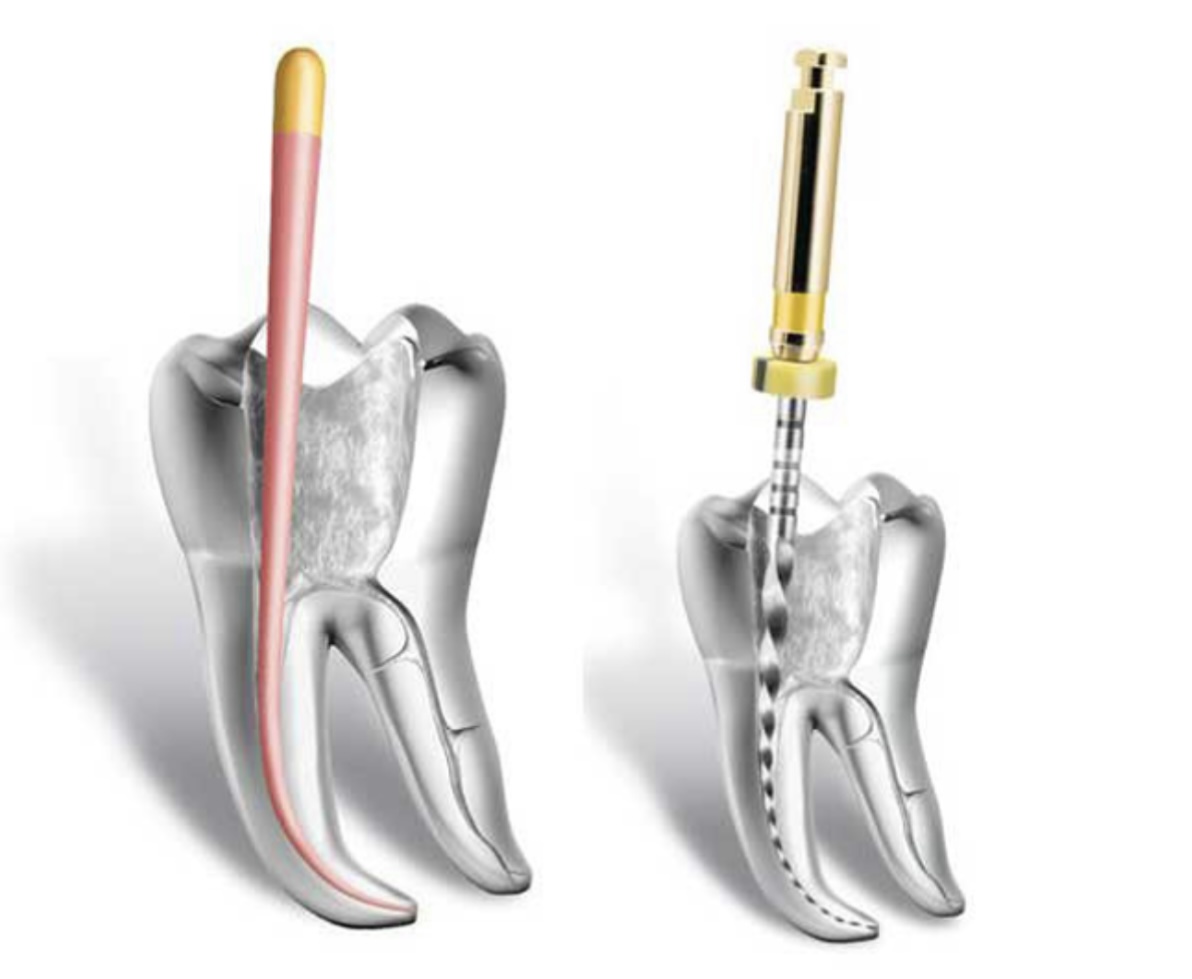 Paso 4: Sellado radicular