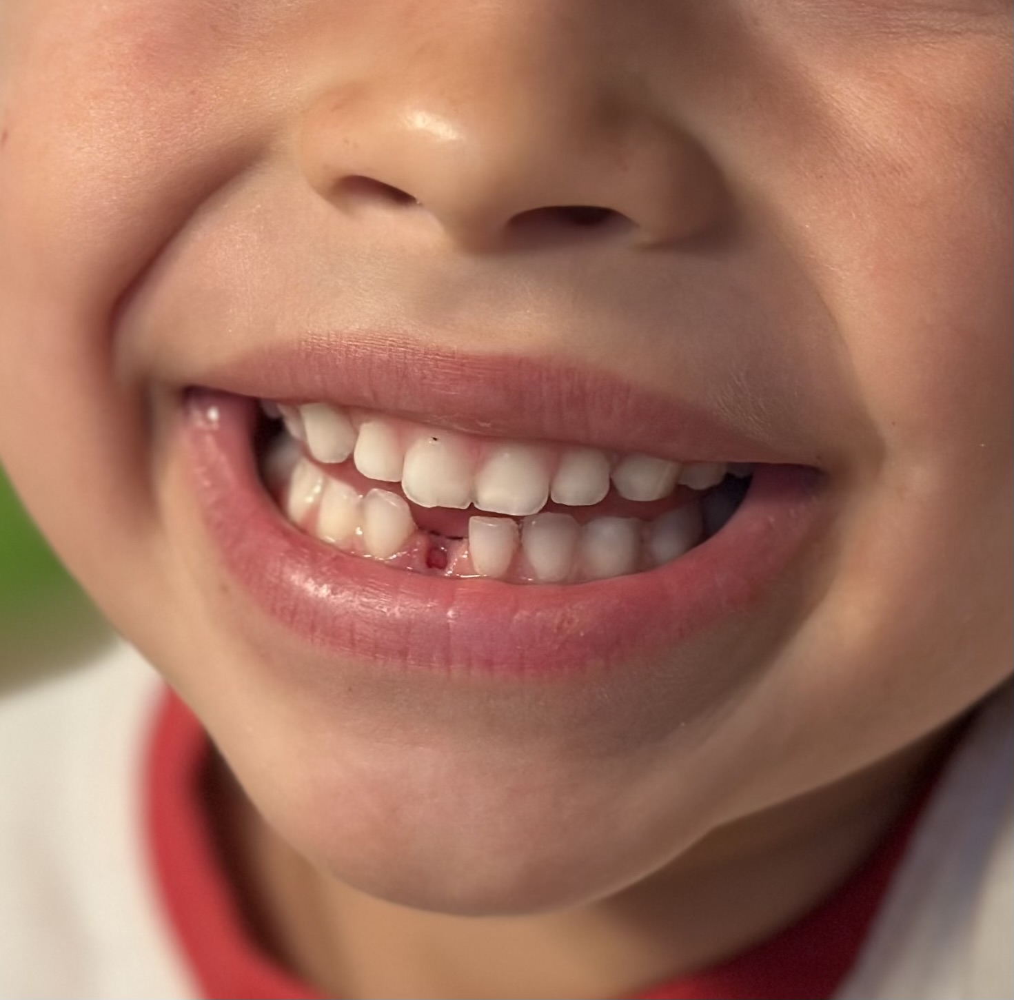 ERUPCIÓN DE LA DENTICIÓN 