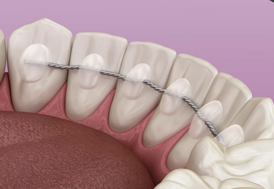 Paso 4: Fase de retención