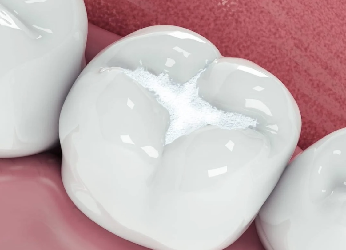 Paso 5: Colocación de una obturación provisional.