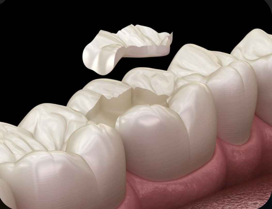 Paso 6: sustitución de la obturación provisional por una definitiva.