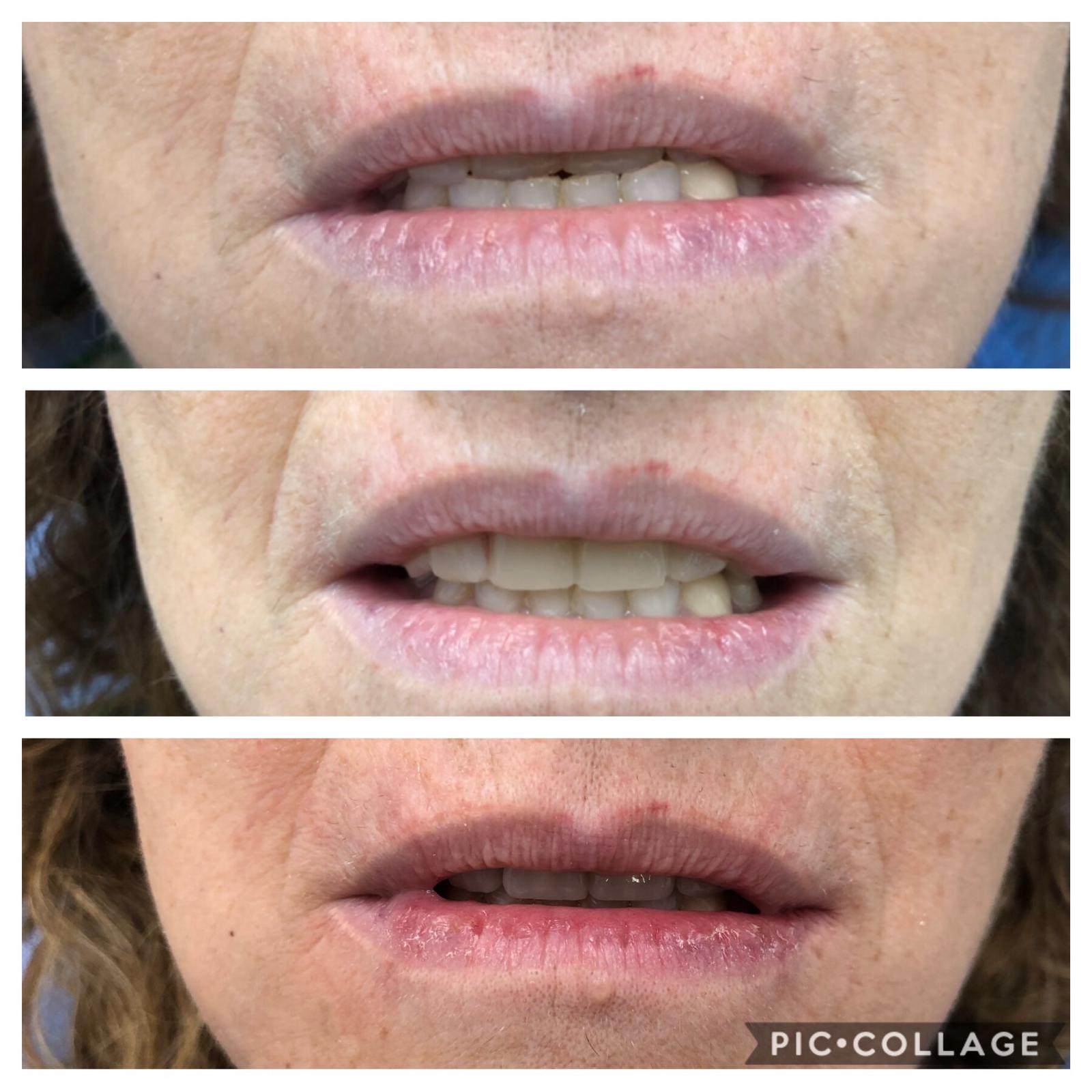 cambio con coronas nuevas modificando oclusion