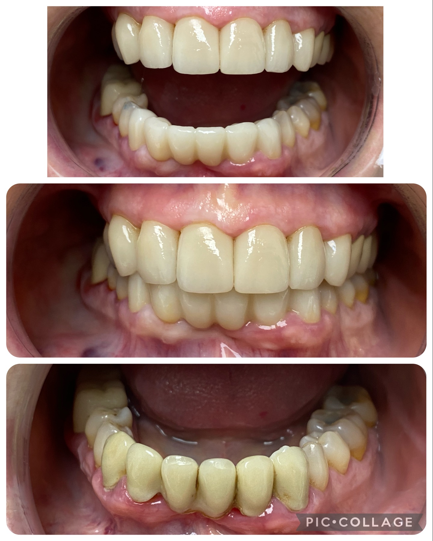 cambio de puente anterior inferior