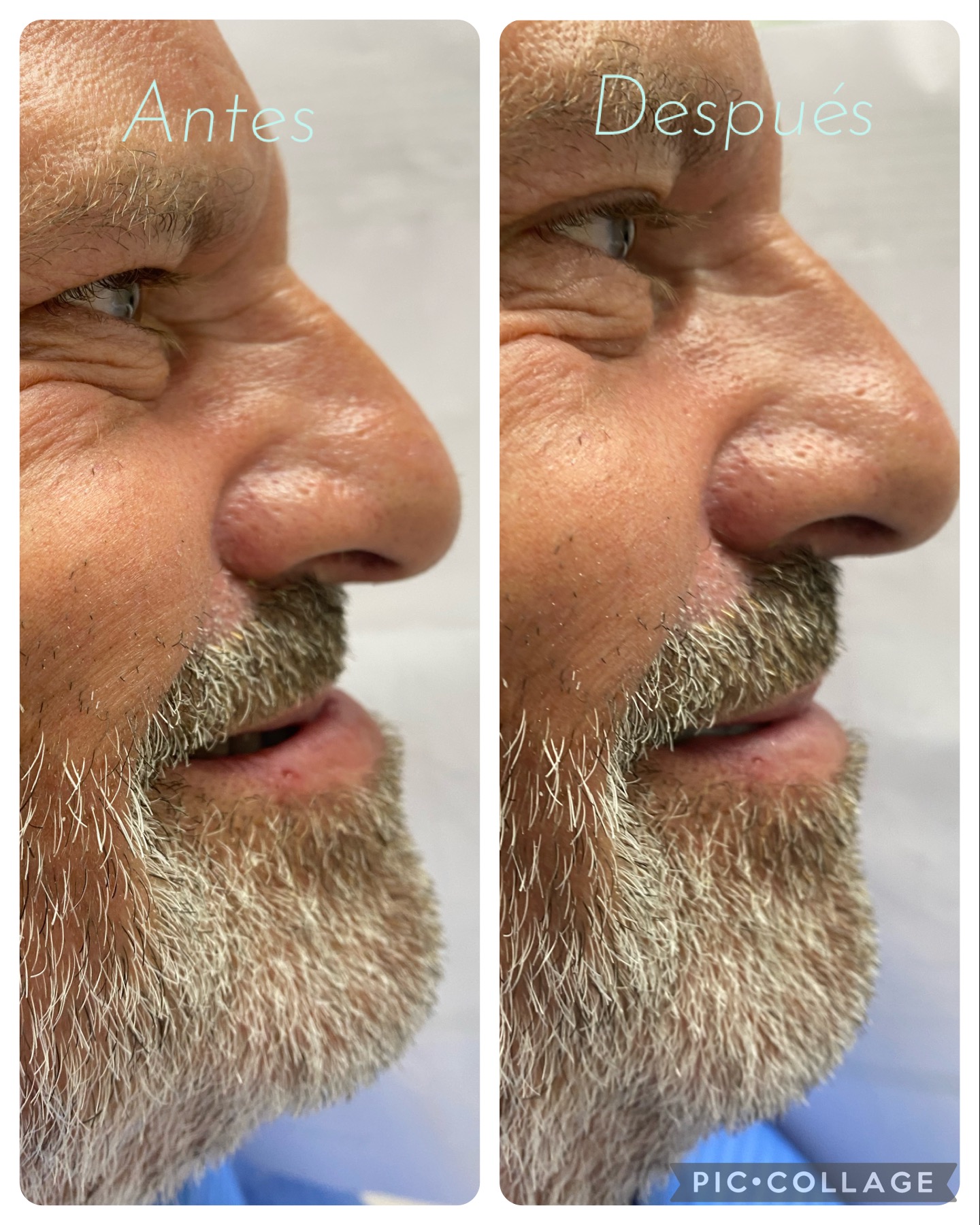 cambio perfil con modificacion de mordida