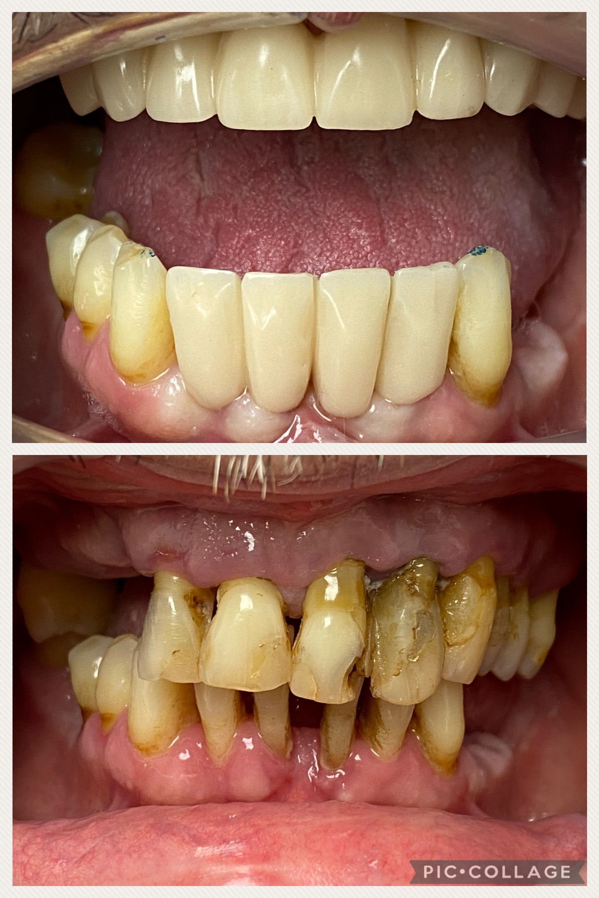 carga inmediata inferior