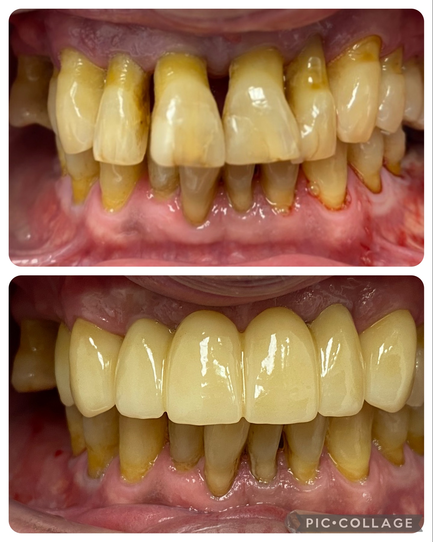 carga inmedita en dientes con enfermedad periodontal con movilidad