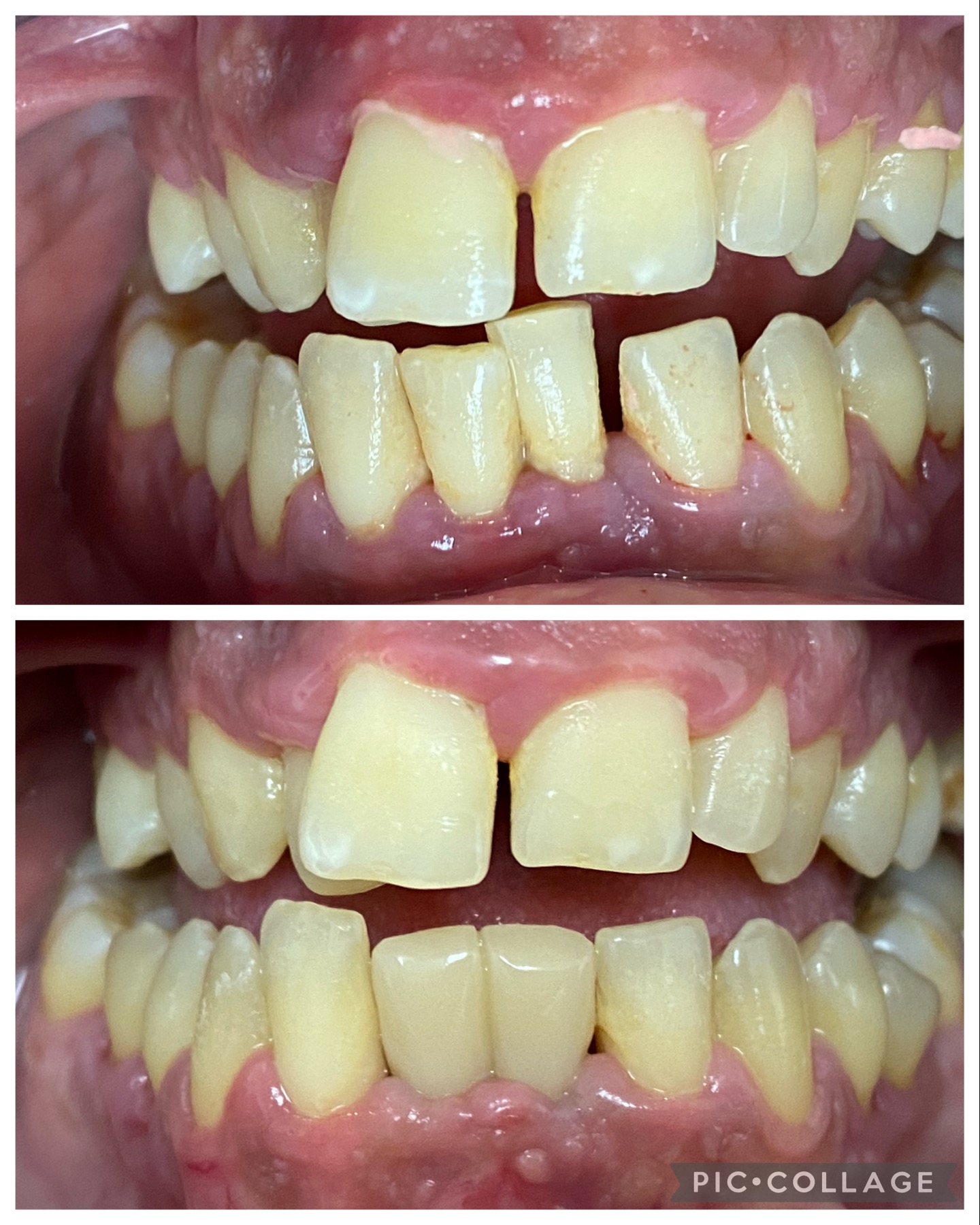 carga inmedita inferior