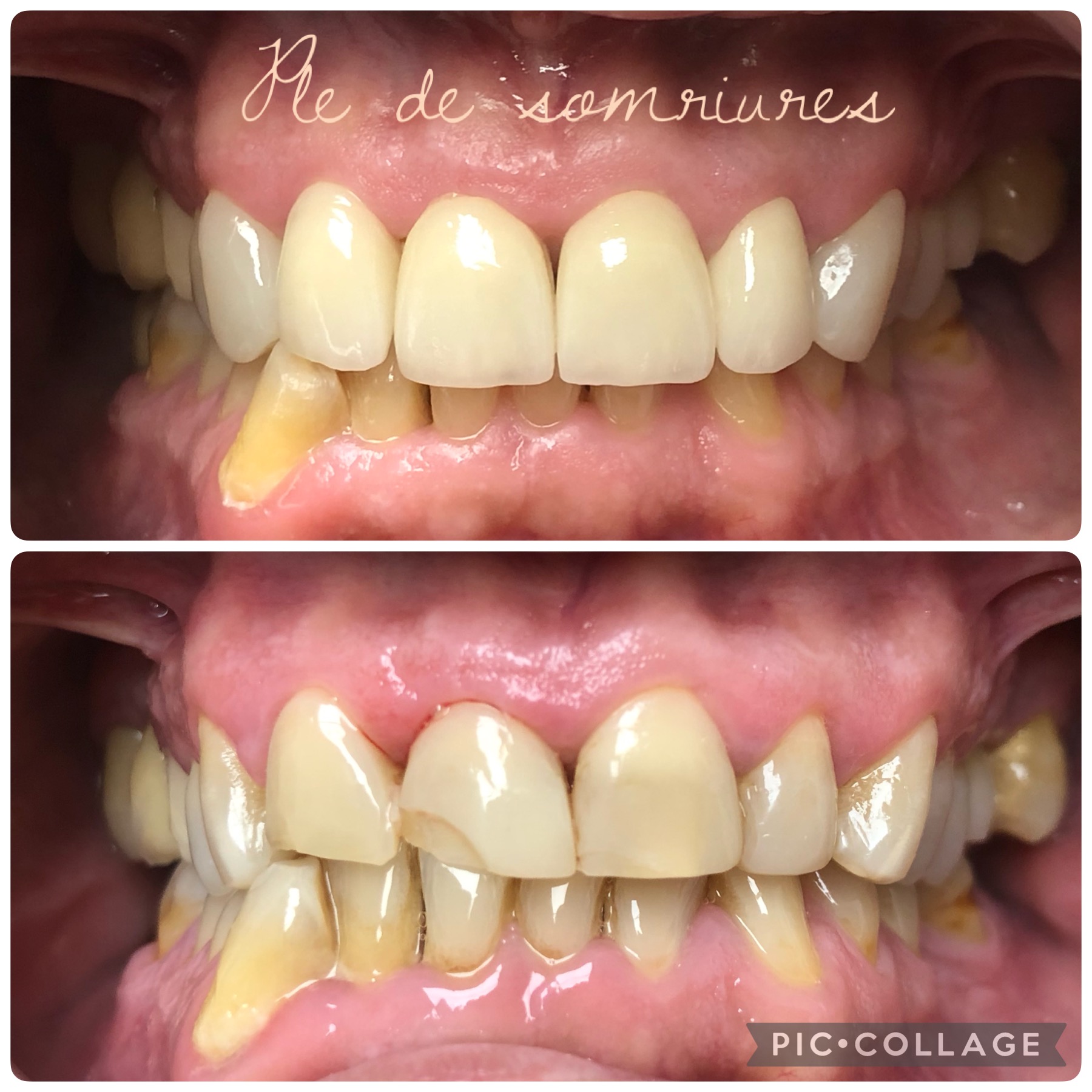 coronas estetica anterior