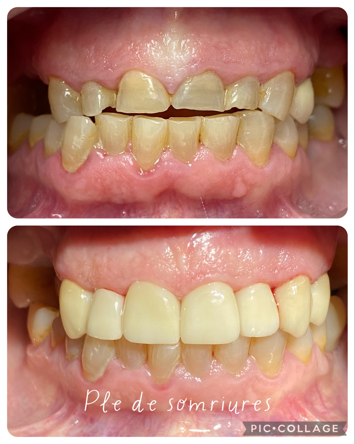 dientes cortos rehabiltados paciente bruxista