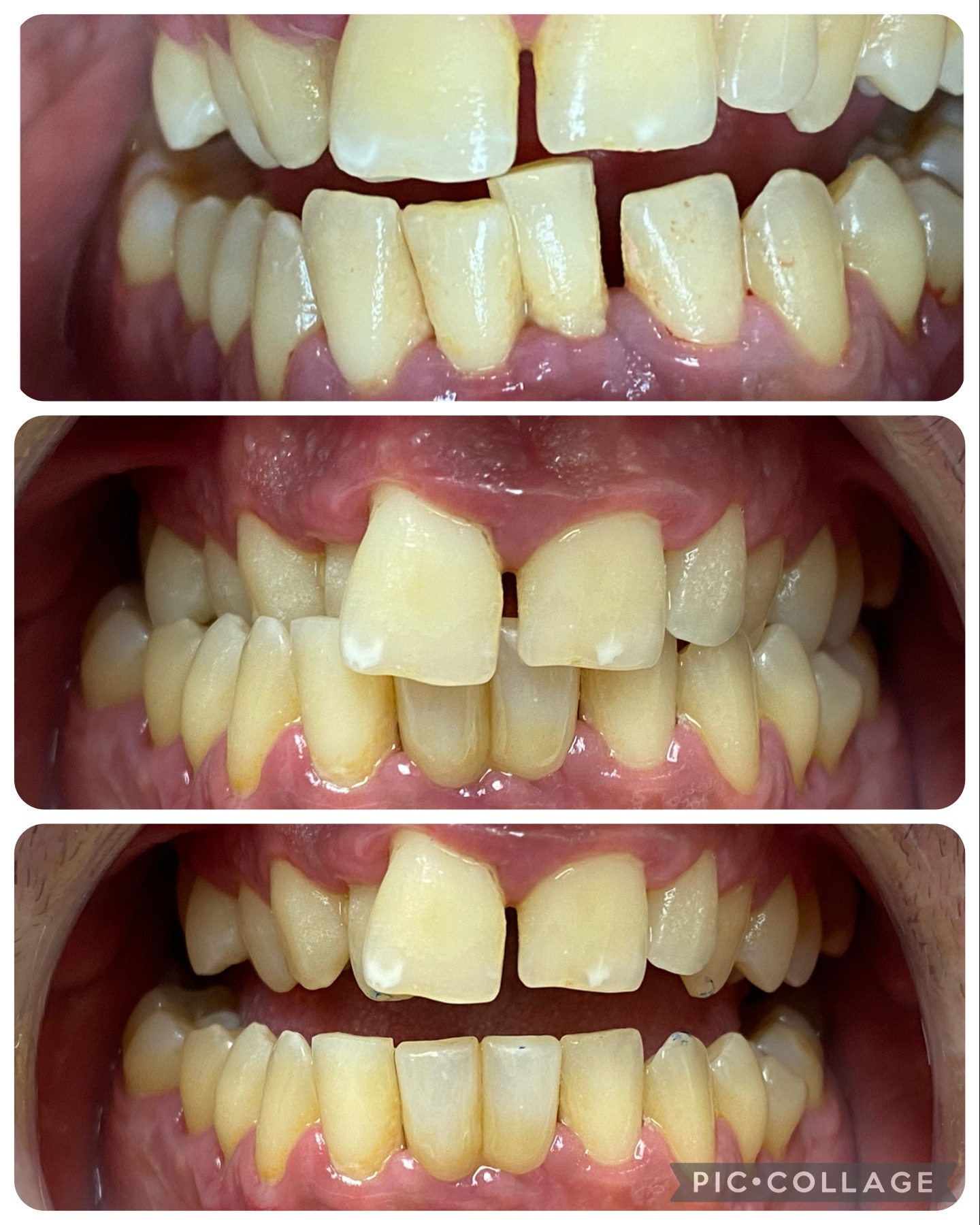 implnates inferiores