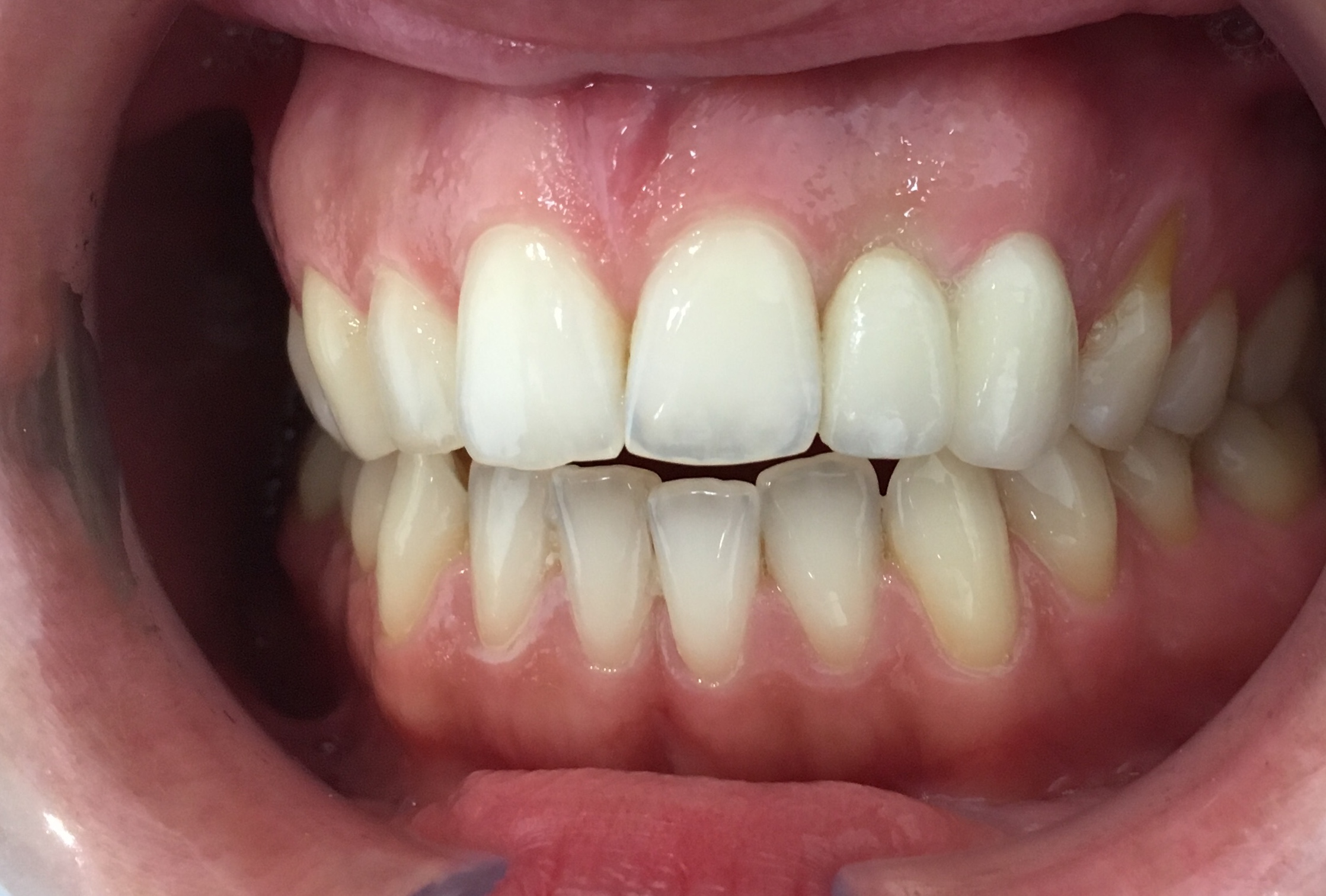 puente en extension del 2.2_2.3 con zirconio