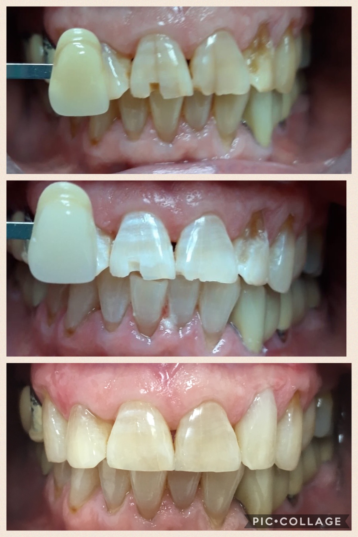 reconstrucciones esteticas con composites