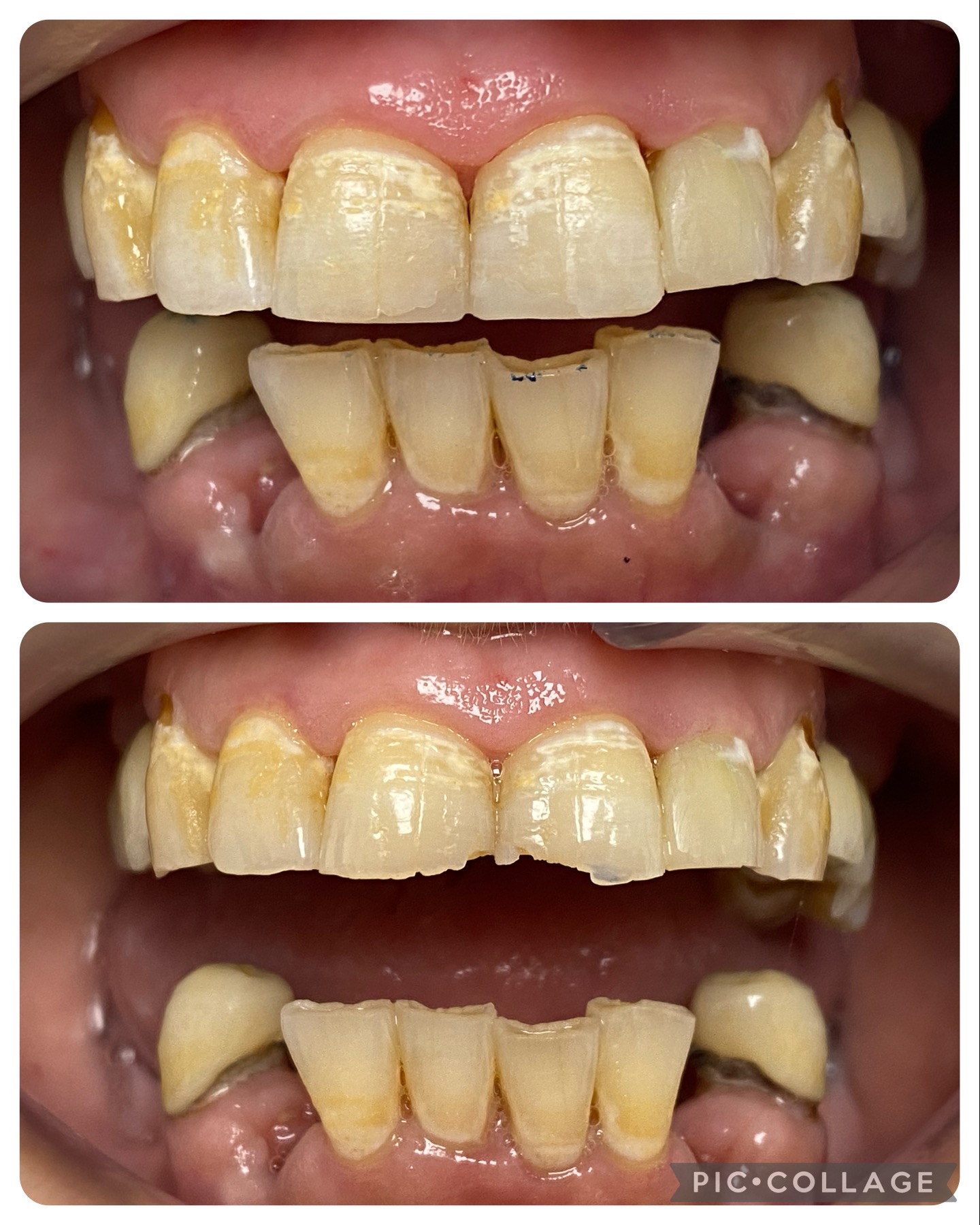 recs esteticas por fractura esmalte