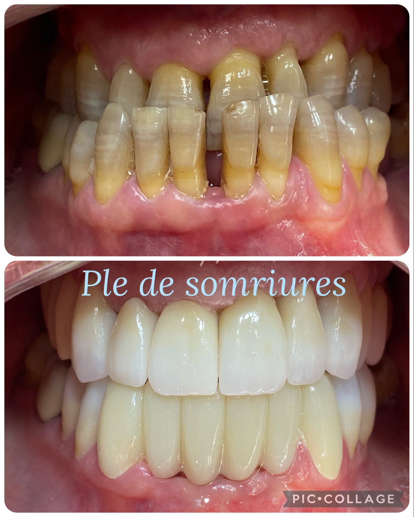 rehabilitacion estetica con cambio de mordida (1)