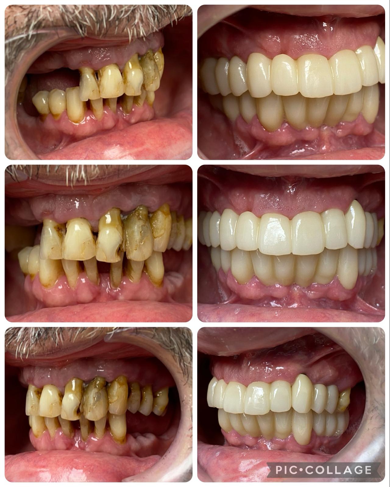 rehabilitacion sobre implantes 2 arcadas (1)
