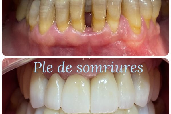 rehabilitacion estetica con cambio de mordida